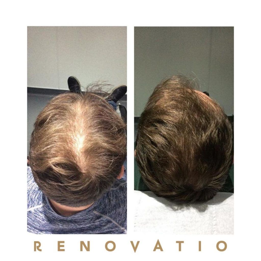 Is PRP Hair Loss Treatment Right for Me? | Renovatio