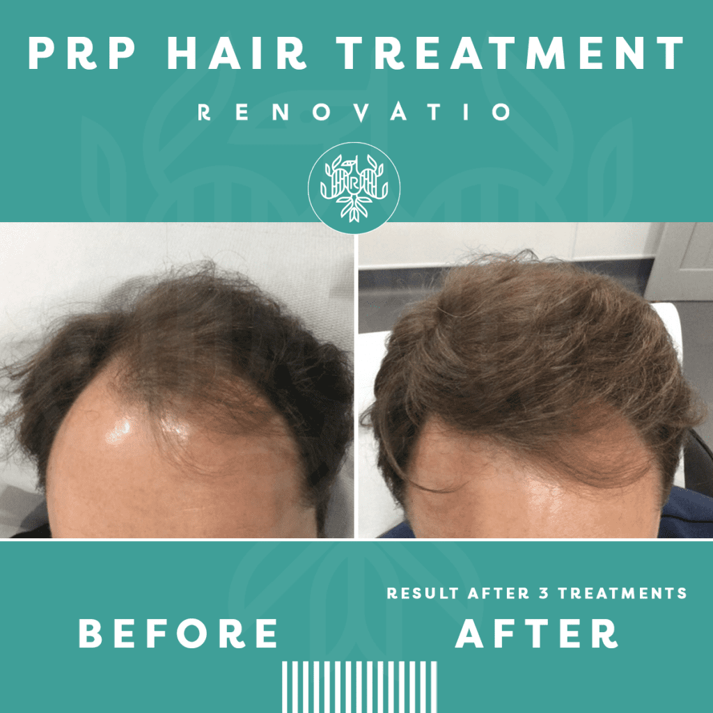 PRP Hair Loss Treatment Manchester | Renovatio Clinic | Cheshire