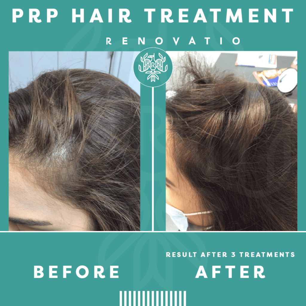 PRP Hair Loss Treatment Manchester | Renovatio Clinic | Cheshire